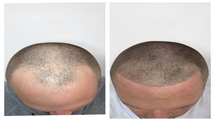 Dry Scalp treatment in Vadodara