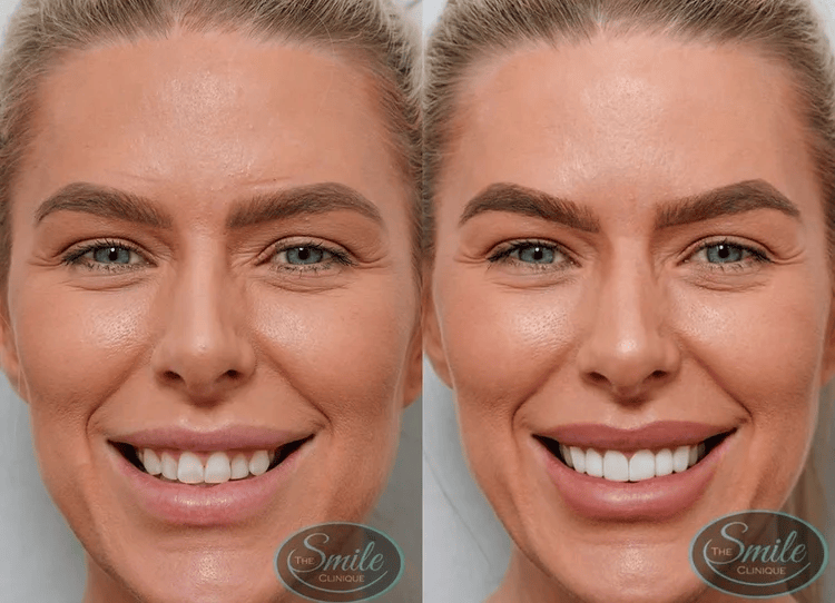 Cosmetic Teeth Whitening Perth Who Can Take Benefit.