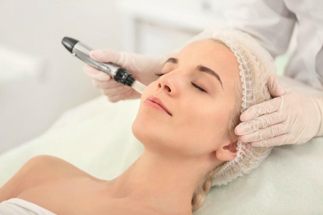 SQT Microneedling London
