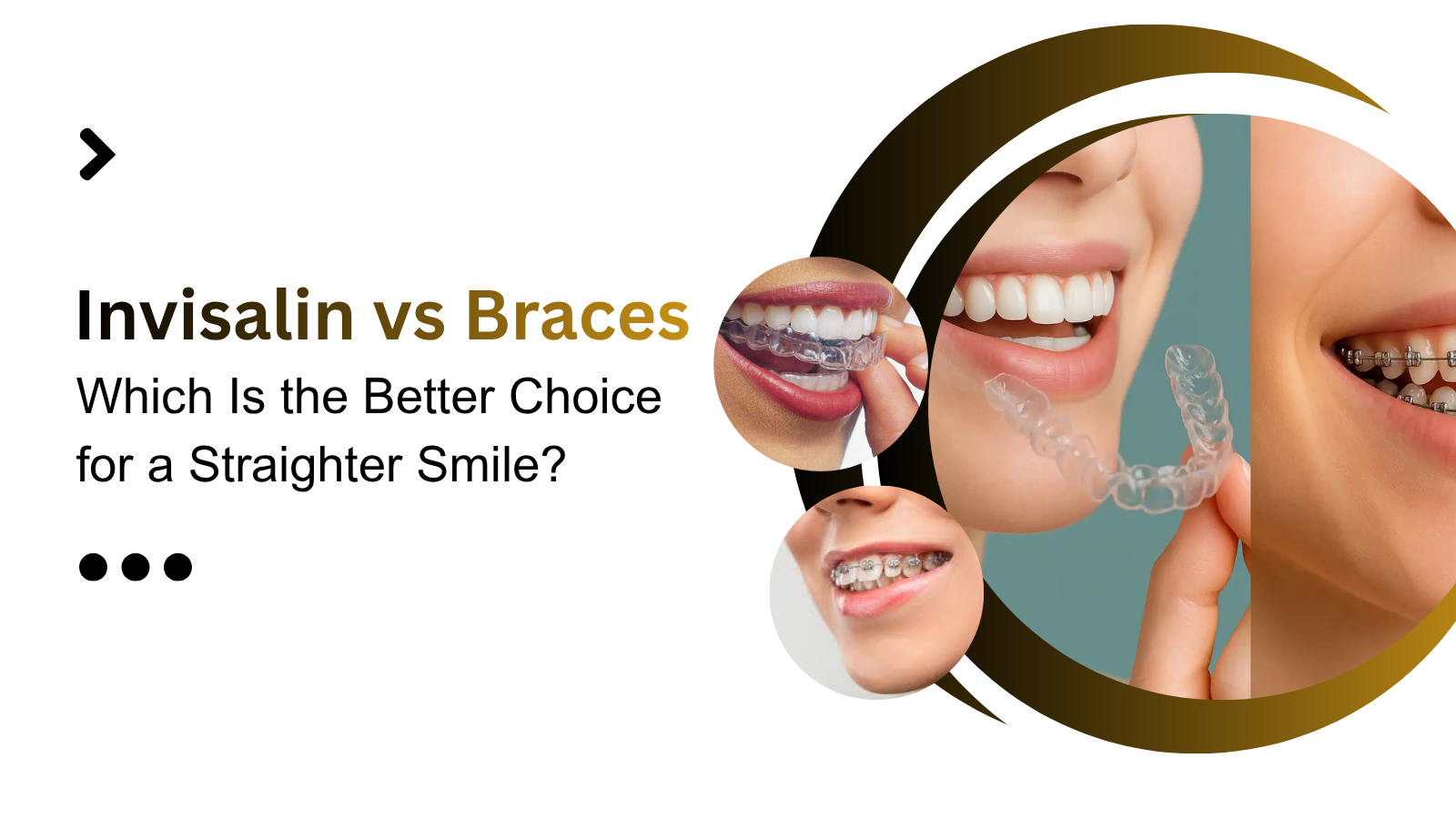Invisalign vs Braces: Which Is the Better Choice for a Straighter Smile?